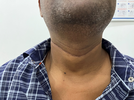 Thyroid Surgery in India